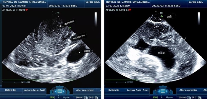 左圖顯示術(shù)中超聲見囊實性病變，大小約為4x4x3cm，病灶周圍腦組織水腫明顯；右圖為病灶切除后，術(shù)中超聲示術(shù)腔無病變殘留