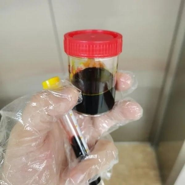 急性肝衰竭！兩兄弟誤吃這種菌 專家提醒