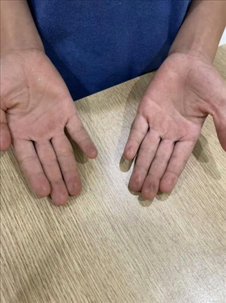 9歲小學(xué)生長(zhǎng)期拍煙卡，手部粗糙長(zhǎng)繭。受訪者供圖