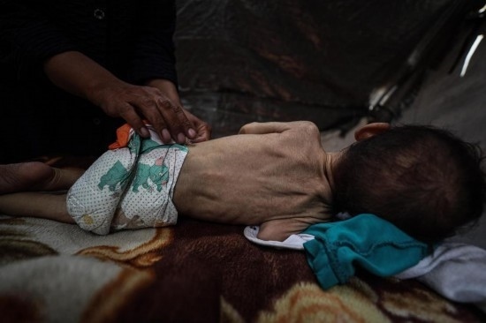 這是5月28日在加沙城西部一處臨時安置點拍攝的一名營養(yǎng)不良的嬰兒。新華社發(fā)（馬哈茂德·扎基攝）